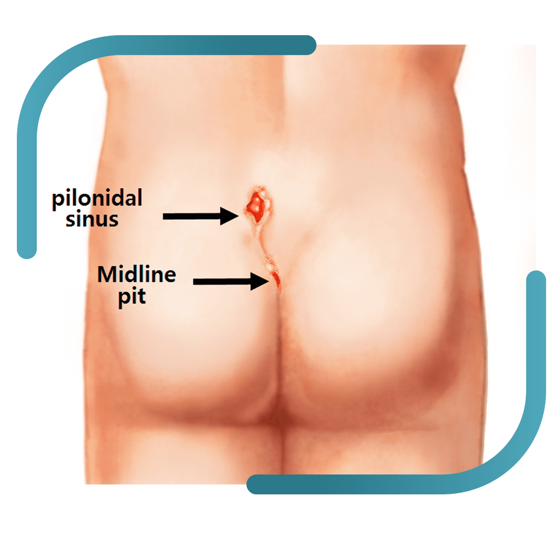 Pilonidal Sinus​ Treatment in Jalandhar