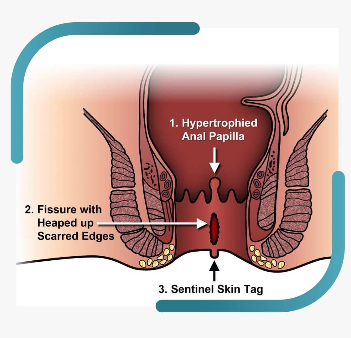 Anal Fissure Treatment In Jalandhar