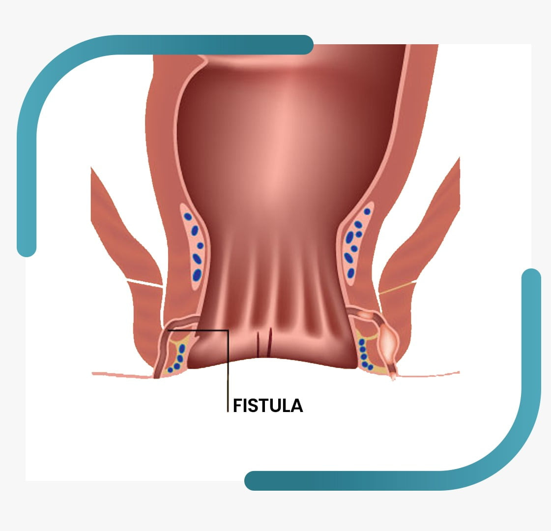 Fistula Treatment in Jalandhar