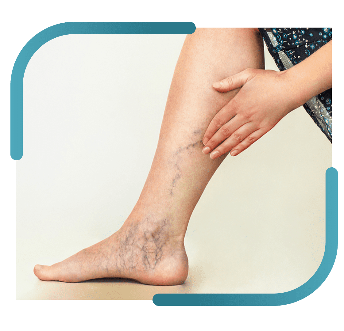 Varicose Veins Treatment In Jalandhar